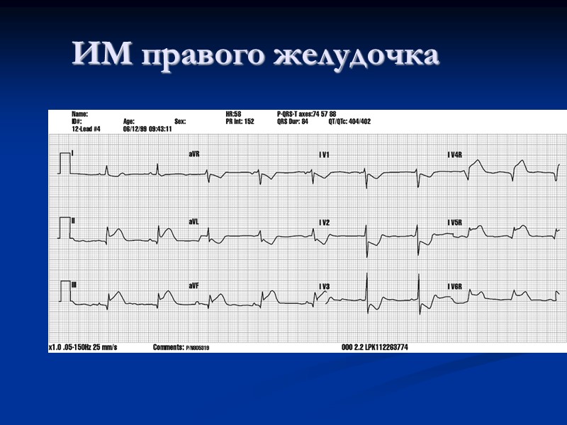 ИМ правого желудочка